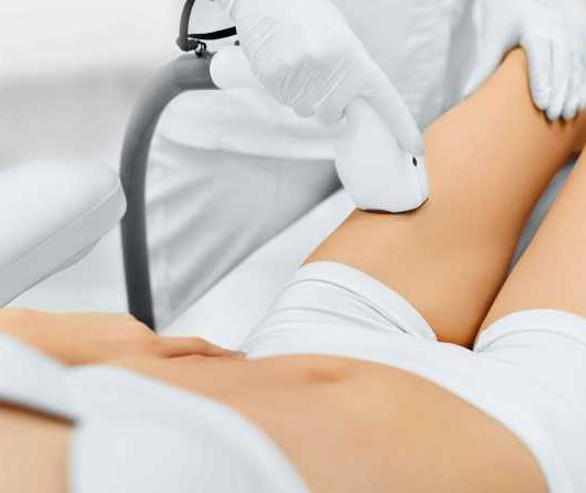 laser hair removal